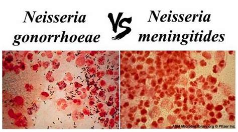 Neisseria Gonorrhoeae & Neisseria Meningitidis - Bacterial Infections ...