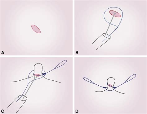 A novel double-endoloop technique for natural orifice transluminal endoscopic surgery gastric ...