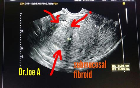 Ultrasound imaging: Submucosal fibroid