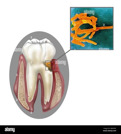 Oral Infection of Fusobacterium Nucleatum Stock Photo - Alamy