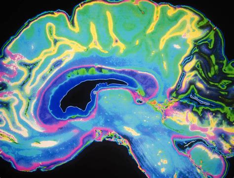 Are There Side Effects from MRI Contrast Dyes? | goop