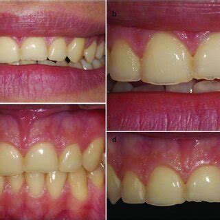 a-d) Initial clinical photos showing the wear on the incisal edges. | Download Scientific Diagram