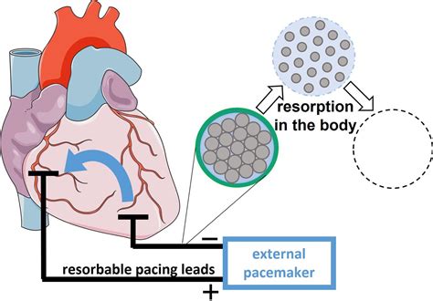 New pacemaker leads would dissolve in the body when no longer needed