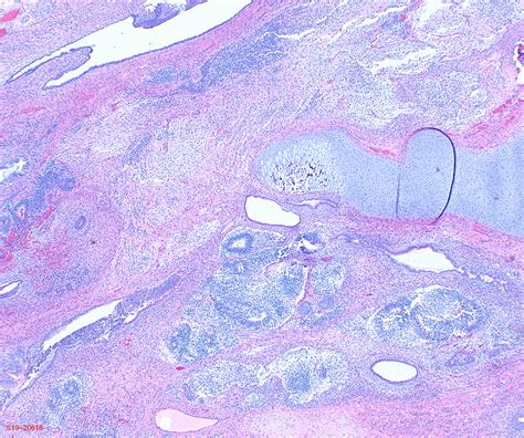 Teratoma Histology