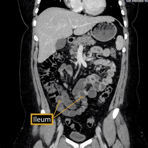 Gross Anatomy Glossary: Small Intestine - Ileum Imaging | Draw It to ...