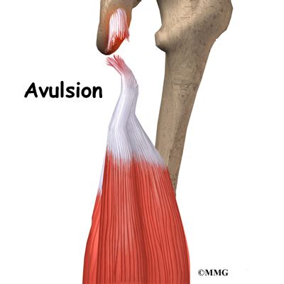 Hamstring Injuries | eOrthopod.com