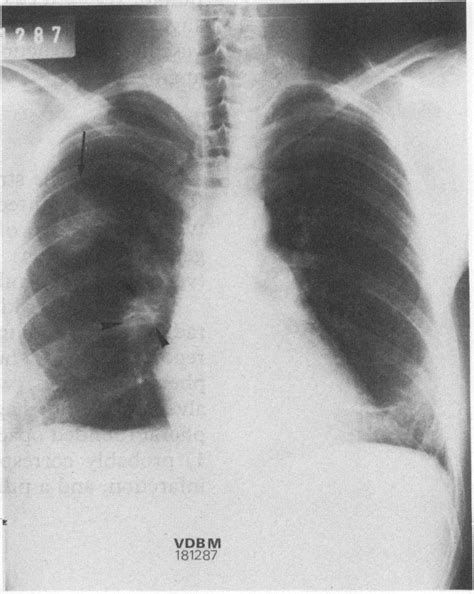 Posteroanterior chest radiograph showing an infiltrate in the right ...