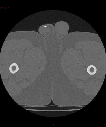 Scrotolith (incidental) | Image | Radiopaedia.org