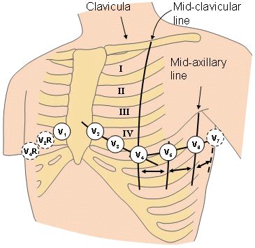 15 lead ecg placement diagram - babyweddingoutfitboynavy