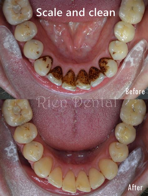 Removal of tartar, plaque and stains on teeth.