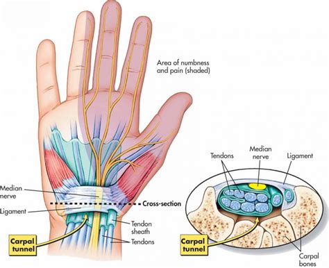 Carpal Tunnel Syndrome - O-health