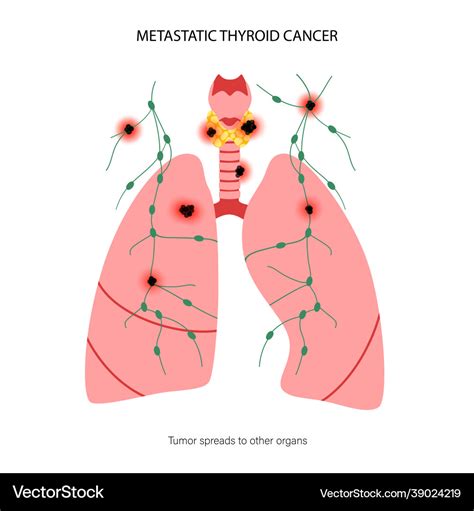 Thyroid cancer stages Royalty Free Vector Image