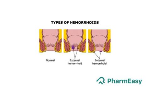 Rubber Band Ligation for Piles: Preparation, Recovery and Risks - PharmEasy Blog