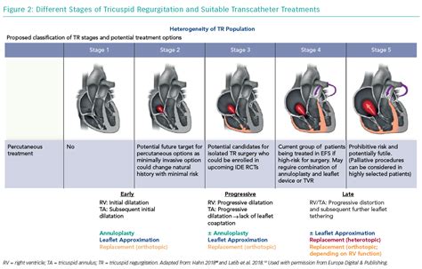 Different Stages of Tricuspid Regurgitation and Suitable Transcatheter ...