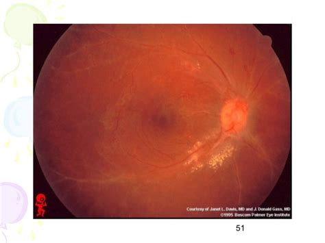 Retinal Vasculitis