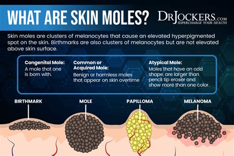 Skin Moles: Signs of Cancer and 10 Natural Removal Strategies