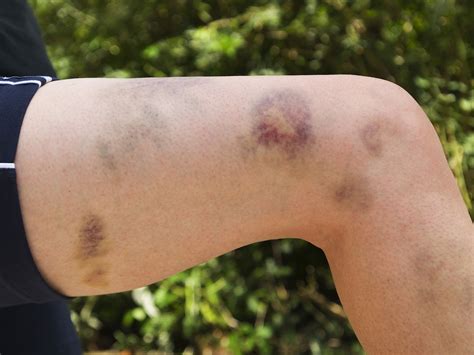 Causes of Easy Bruising: Reasons Why People Bruise Easily