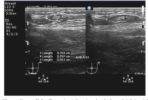 [PDF] Ultrasound Examination of Gynecomastia Case in Male Patient: Case Report | Semantic Scholar