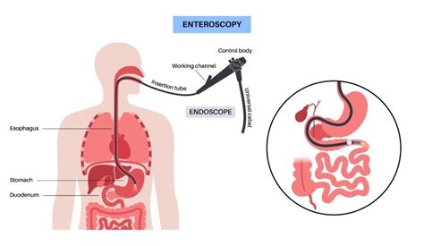 Enteroscopy Procedures in Atlanta, Georgia