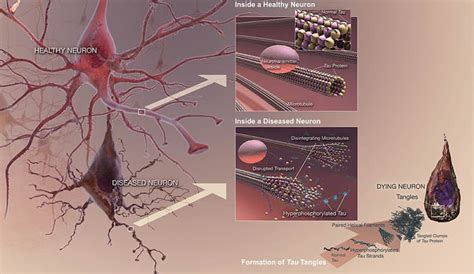 Exercise and Diet Can Reduce Build Up of Protein Linked to Alzheimer's ...