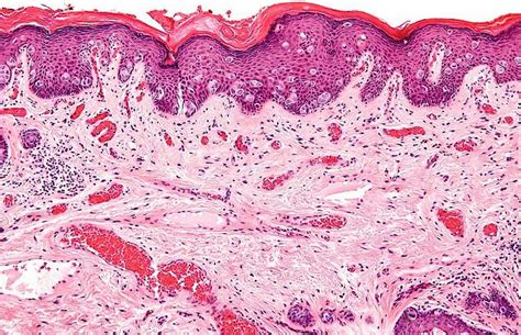 Stages Of Paget's Disease Skin