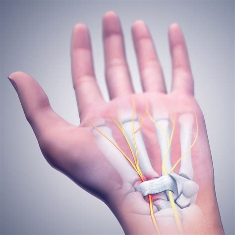 Een brace bij RSI - Helpt een brace? - Hoe kies je de juiste brace?