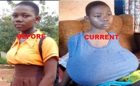 This JHS3 student is suffering breast hypertrophy - NewsGhana24