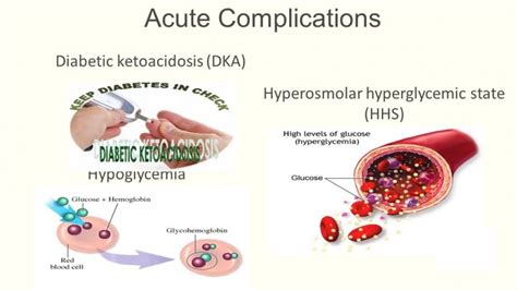 Diabetic Hyperosmolar Syndrome Causes, Symptoms, Diagnosis And Treatment - Natural Health News