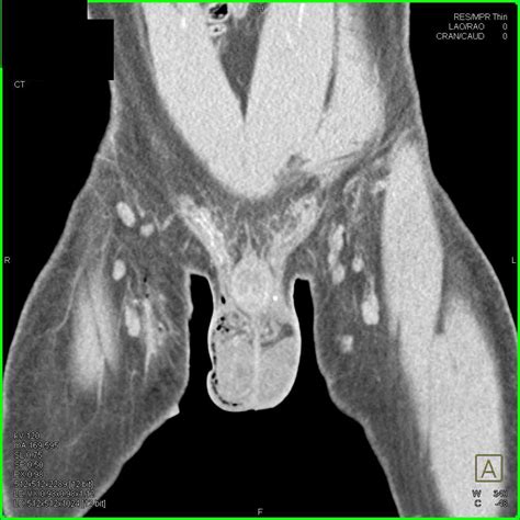 Scrotal Diagram