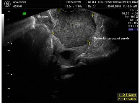 Cancer Cervix Ultrasound