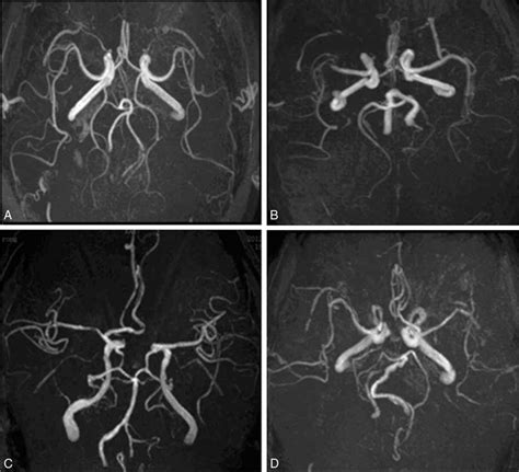 Circle Of Willis Mri