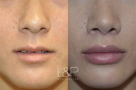 Lip Lift Before and After Photos Case 71 | Palo Alto & San Jose, California | L&P Aesthetics