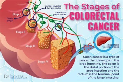 Colon Cancer: Symptoms, Causes and Support Strategies