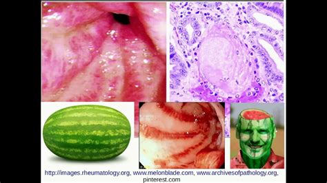 Histopathology - Gastric Antral Vascular ectasia (GAVE) - YouTube