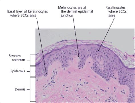 Squamous Cell Carcinoma Histology