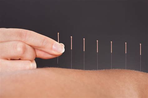 Acupuncturists Near Me! At ARC Acupuncture & Physical Therapy