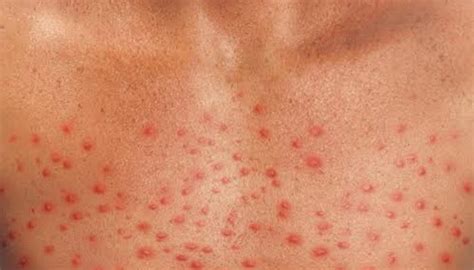 Cirrhosis Rash: Is Your Rash Caused By Hepatitis? - Fatty Liver Disease