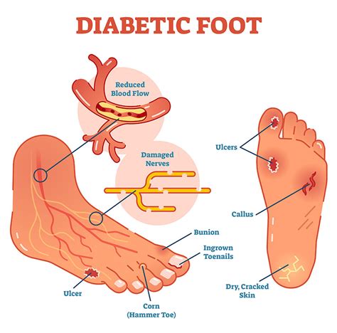 Diabetic Foot Care at the SCMSC | Call 818-900-6480