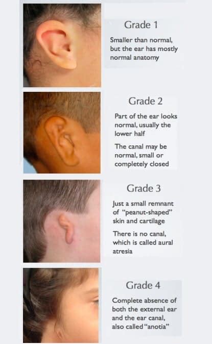 Microtia Surgery Indore, India - Microtia Ear Reconstruction, Repair Plastic Surgery In Indore ...