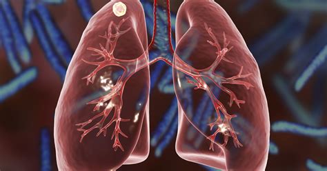 Lung Nodules and How They Relate to Lung Cancer | El Camino Health