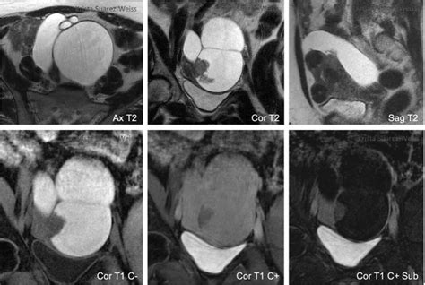 Adnexal Lesions: O-RADS MRI - RAD-ASSIST