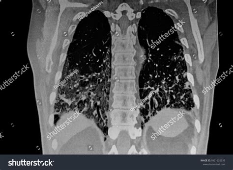 Chest Ct Scan Novel Coronavirus Covid19 Stock Photo 1921635935 ...