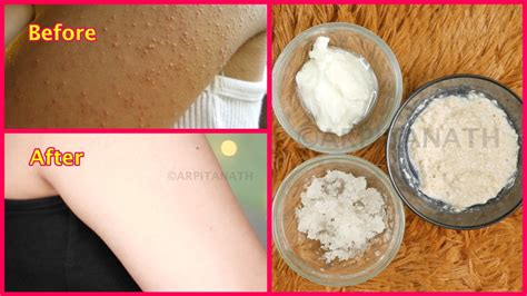 Nice Info About How To Get Rid Of Spots On Arms - Effectsteak33