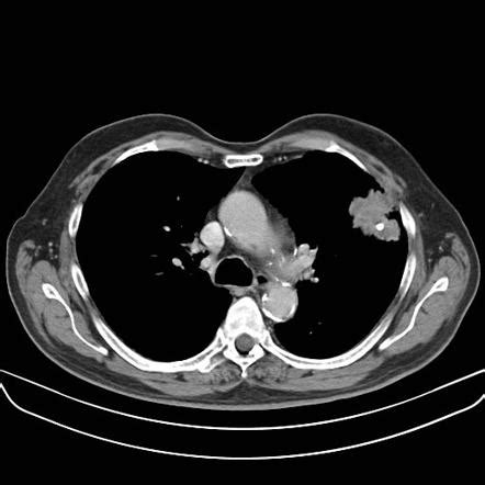 Squamous Cell Carcinoma Lung Gross