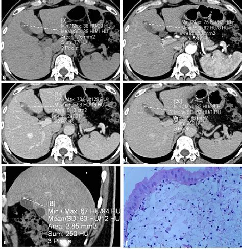 A 56-year-old man with a 13-mm GB polyp. A perceptible GB polyp is ...