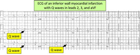 Defining, Deducing, & Diagnosing With ECGs | ECGEDU.com