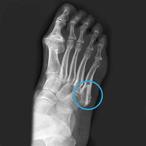 Metatarsal Bone Fracture