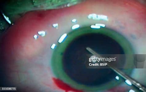 294 Eye Implant Stock Photos, High-Res Pictures, and Images - Getty Images