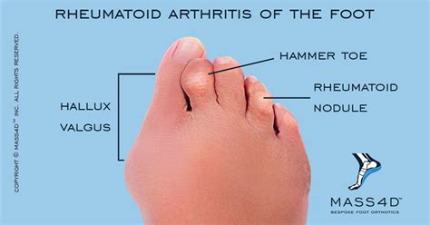 Rheumatoid Arthritis Feet