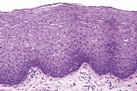 Diseases of the oral mucosa | Basicmedical Key